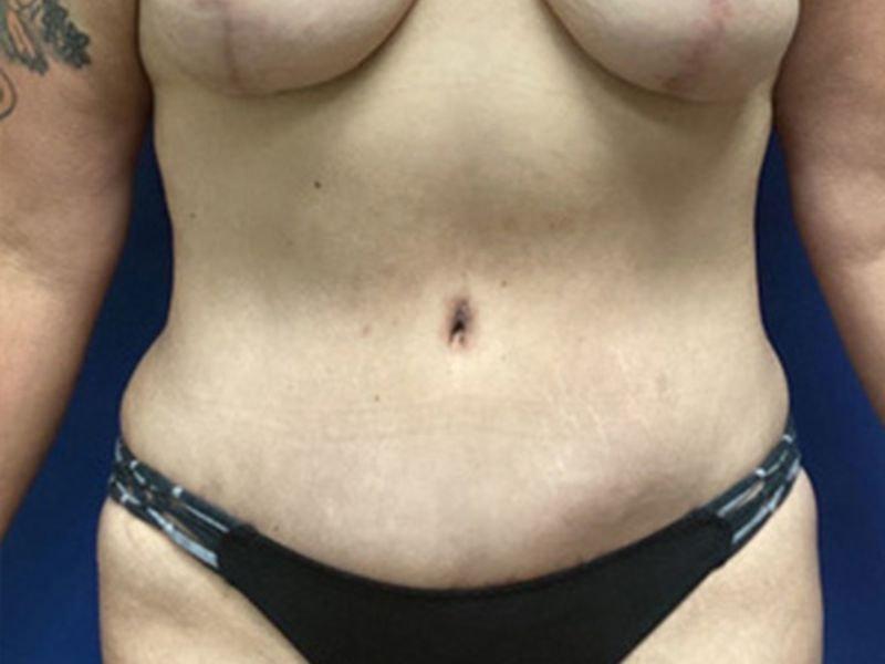 Vandegrift Plastic Surgery tummy tuck after — Huntington, NY