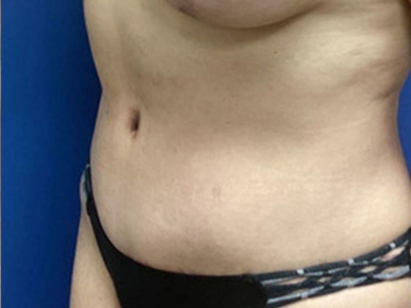 Vandegrift Plastic Surgery tummy tuck after — Huntington, NY