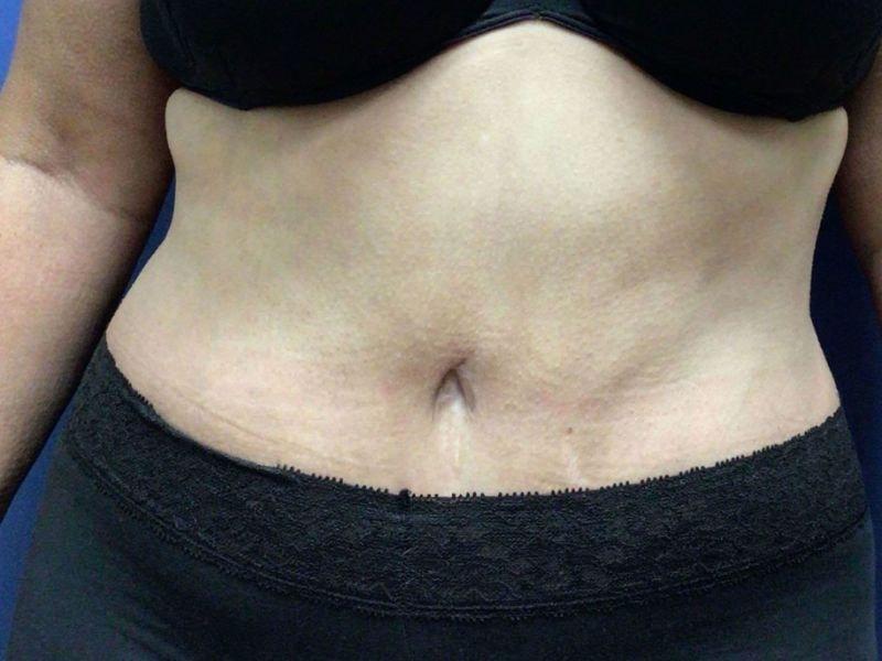 Vandegrift Plastic Surgery tummy tuck after — Huntington, NY