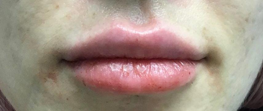 Buffalo Plastic Surgery lip filler result — Amherst, NY