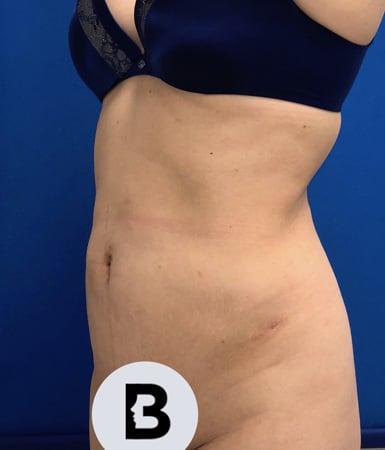 Buffalo Plastic Surgery liposuction after — Amherst, NY