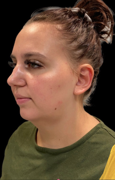 Fat Transfer before at Buffalo Plastic Surgery in Amherst, NY