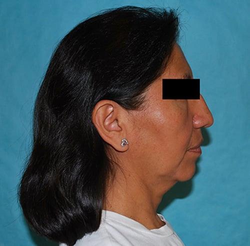 Deep Plane Facelift before at Buffalo Plastic Surgery in Amherst, NY
