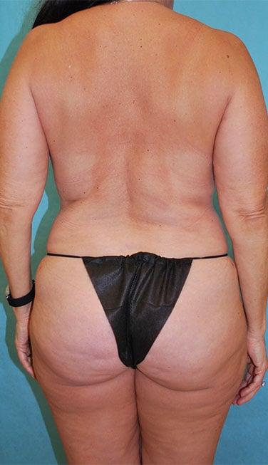 Buffalo Plastic Surgery liposuction after — Amherst, NY