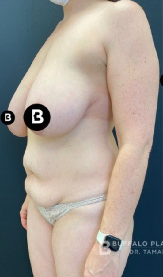 Mommy Makeover before at Buffalo Plastic Surgery in Amherst, NY