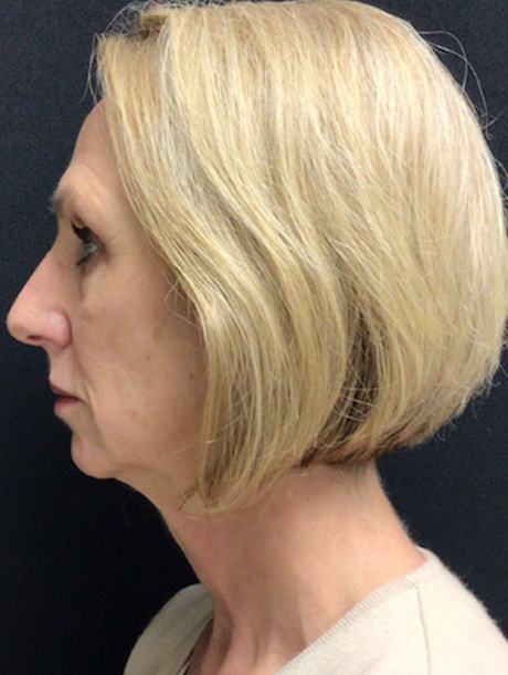 Deep Plane Facelift before at Buffalo Plastic Surgery in Amherst, NY