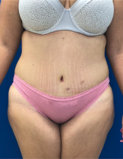 Buffalo Plastic Surgery liposuction after — Amherst, NY