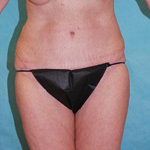 Buffalo Plastic Surgery tummy tuck after — Amherst, NY