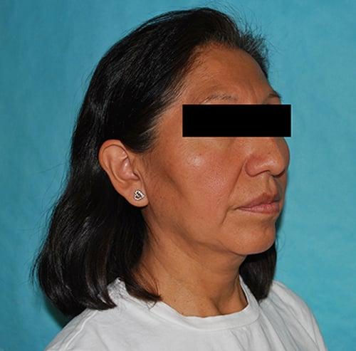 Deep Plane Facelift before at Buffalo Plastic Surgery in Amherst, NY