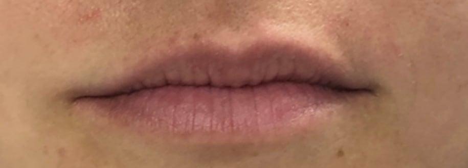 Buffalo Plastic Surgery lip filler result — Amherst, NY