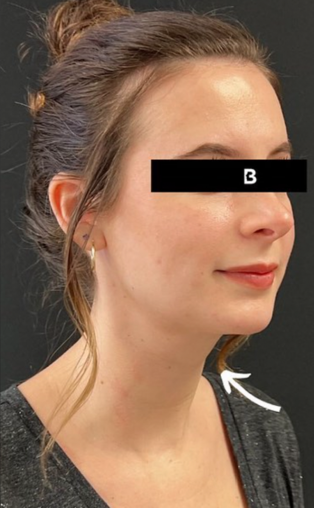 Fat Transfer after at Buffalo Plastic Surgery in Amherst, NY