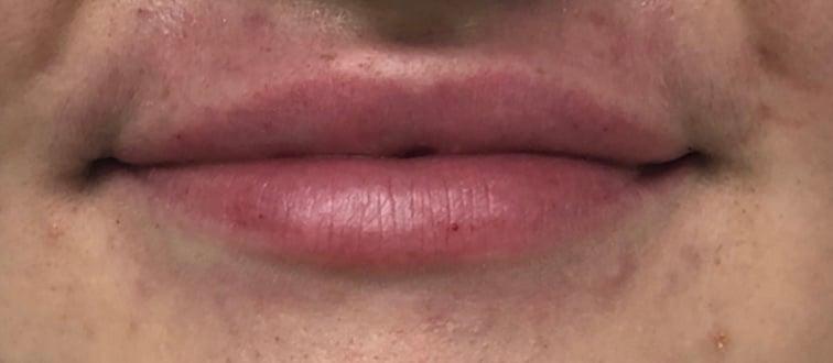 Buffalo Plastic Surgery lip filler after — Amherst, NY