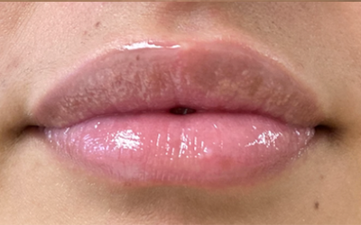 Buffalo Plastic Surgery lip filler after — Amherst, NY