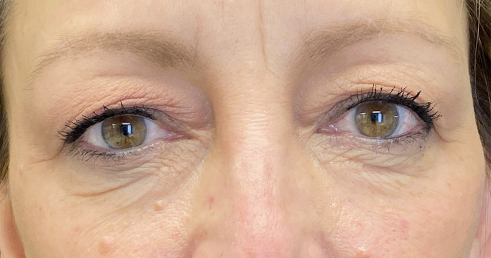 Buffalo Plastic Surgery blepharoplasty result — Amherst, NY