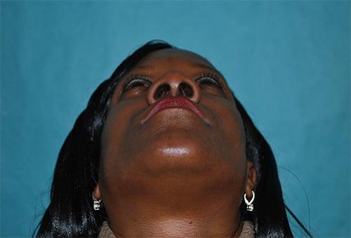 Rhinoplasty before at Buffalo Plastic Surgery in Amherst, NY