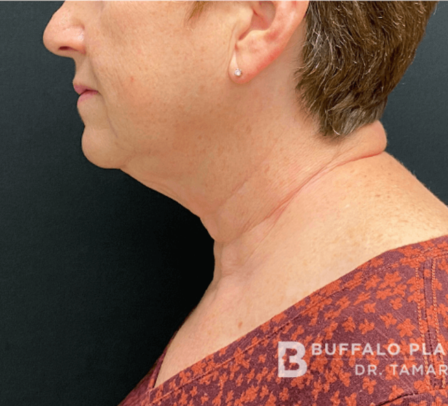 Neck Lift before at Buffalo Plastic Surgery in Amherst, NY