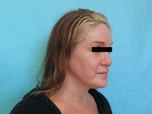Buffalo Plastic Surgery facelift after — Amherst, NY