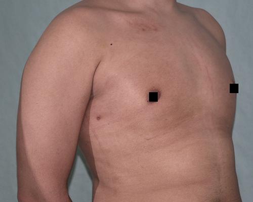 Buffalo Plastic Surgery gynecomastia after — Amherst, NY