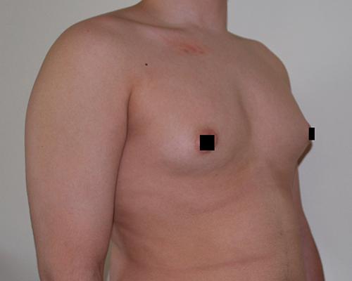 Gynecomastia Surgery before at Buffalo Plastic Surgery in Amherst, NY