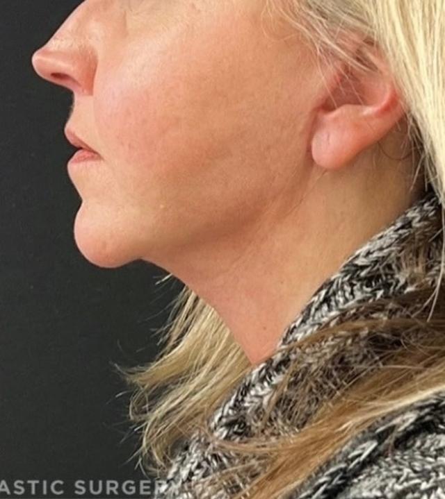 Neck Lift after at Buffalo Plastic Surgery in Amherst, NY