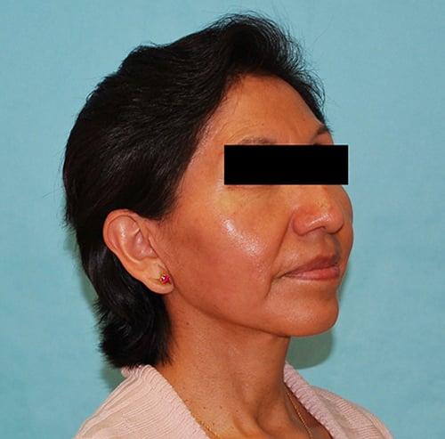 Buffalo Plastic Surgery facelift after — Amherst, NY