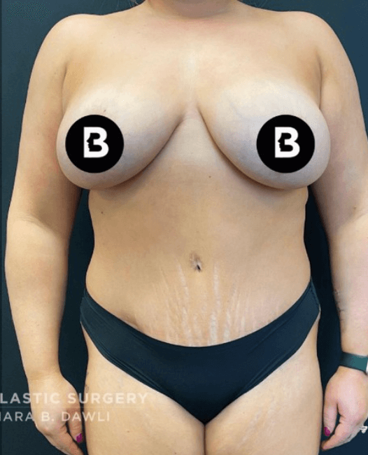 Buffalo Plastic Surgery mommy makeover after — Amherst, NY
