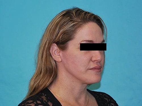 Deep Plane Facelift before at Buffalo Plastic Surgery in Amherst, NY