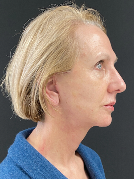 Deep Plane Facelift after at Buffalo Plastic Surgery in Amherst, NY