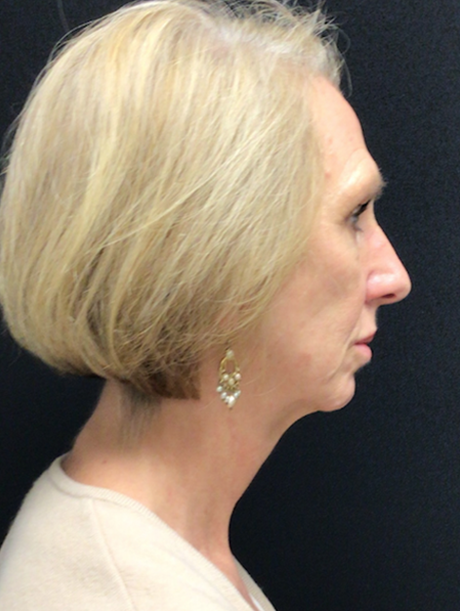 Deep Plane Facelift before at Buffalo Plastic Surgery in Amherst, NY
