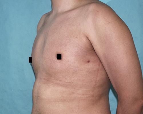 Buffalo Plastic Surgery gynecomastia after — Amherst, NY