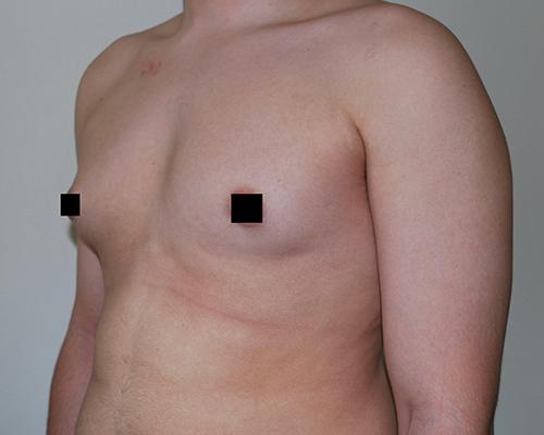 Gynecomastia Surgery before at Buffalo Plastic Surgery in Amherst, NY