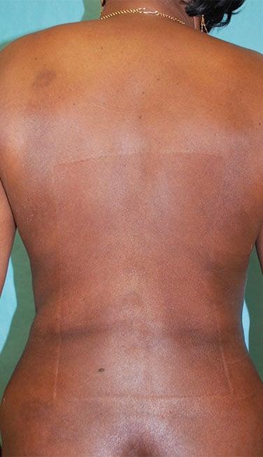 Buffalo Plastic Surgery liposuction after — Amherst, NY