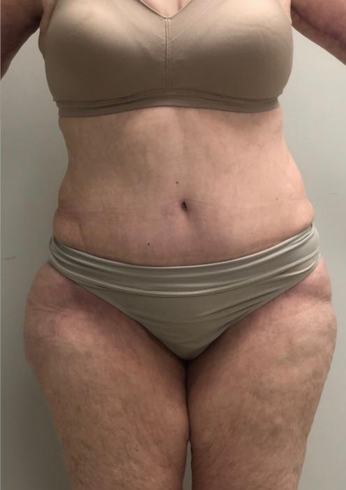 Buffalo Plastic Surgery tummy tuck after — Amherst, NY