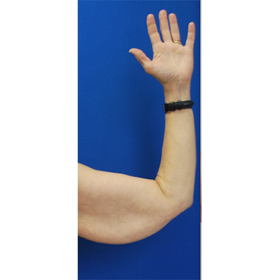 Arm Lift before at Buffalo Plastic Surgery in Amherst, NY