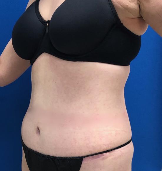 Buffalo Plastic Surgery tummy tuck after — Amherst, NY