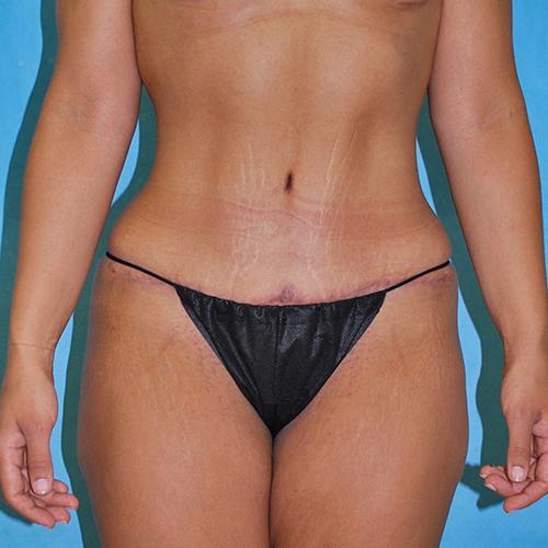 Buffalo Plastic Surgery tummy tuck after — Amherst, NY