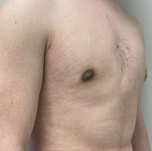 Buffalo Plastic Surgery gynecomastia after — Amherst, NY