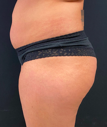 Brazilian Butt Lift before at Buffalo Plastic Surgery in Amherst, NY