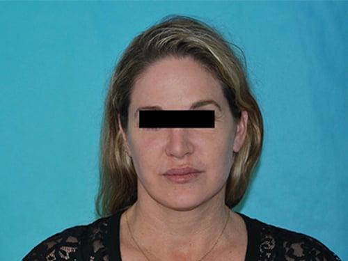 Buffalo Plastic Surgery facelift after — Amherst, NY