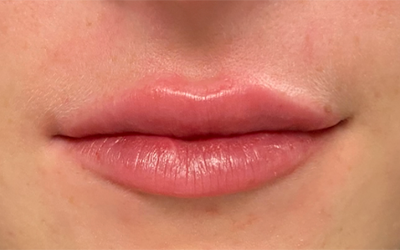 Buffalo Plastic Surgery lip filler after — Amherst, NY