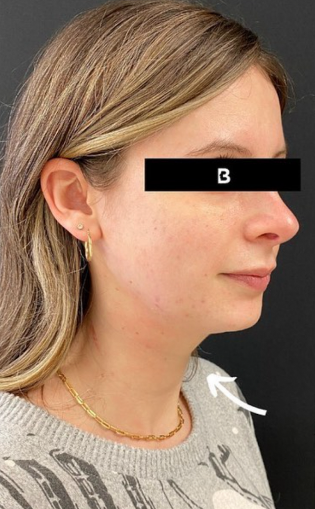 Fat Transfer before at Buffalo Plastic Surgery in Amherst, NY
