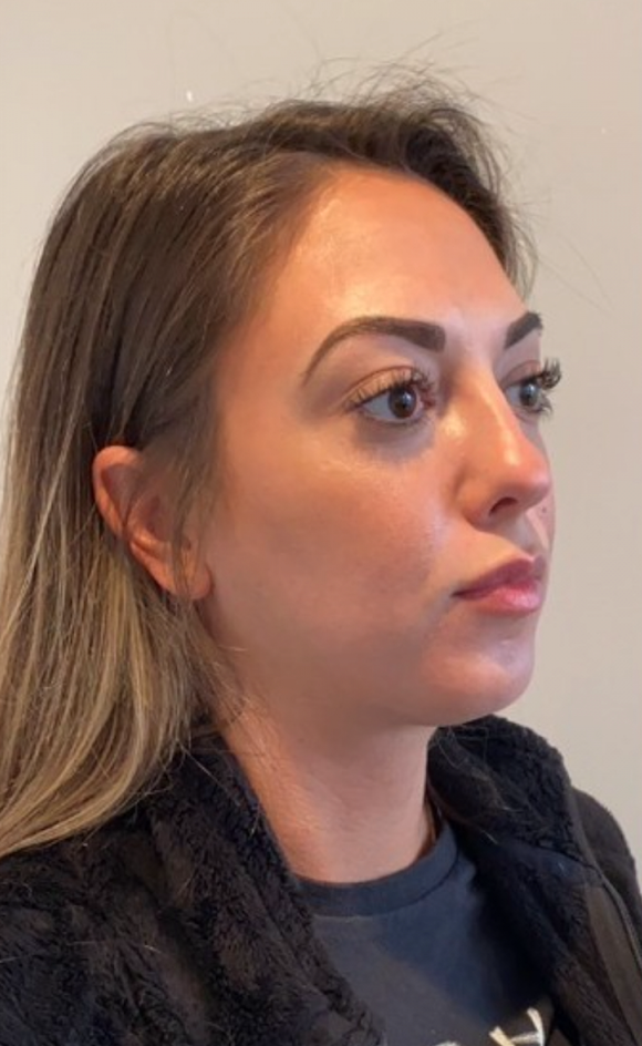 Fat Transfer before at Buffalo Plastic Surgery in Amherst, NY