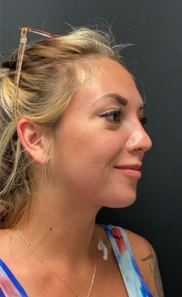 Buffalo Plastic Surgery fat transfer after — Amherst, NY