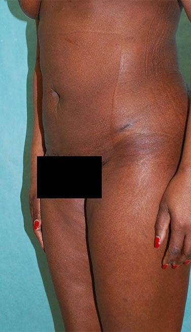 Buffalo Plastic Surgery liposuction after — Amherst, NY