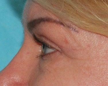 Buffalo Plastic Surgery blepharoplasty after — Amherst, NY
