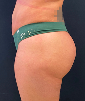 Buffalo Plastic Surgery bbl after — Amherst, NY