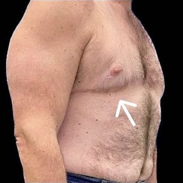 Breast Reduction after at Buffalo Plastic Surgery in Amherst, NY