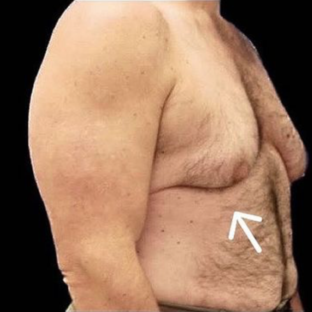 Breast Reduction before at Buffalo Plastic Surgery in Amherst, NY