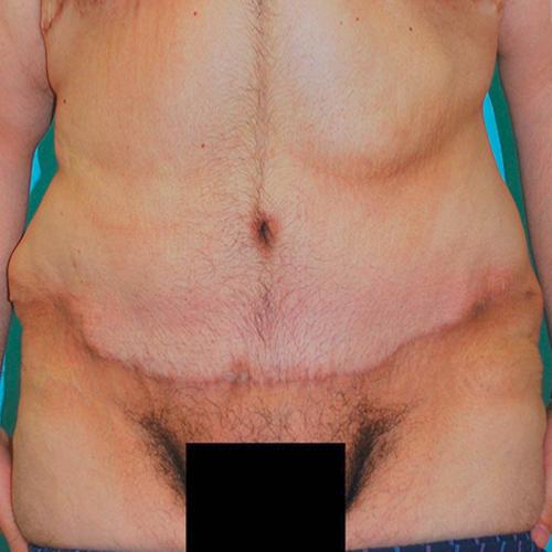 Tummy Tuck after at Buffalo Plastic Surgery in Amherst, NY