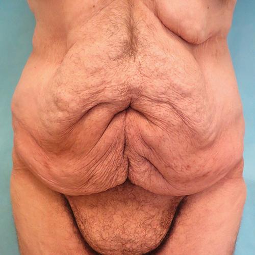 Tummy Tuck before at Buffalo Plastic Surgery in Amherst, NY